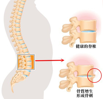 增生性骨关节病