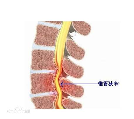 颈椎腰椎管狭窄